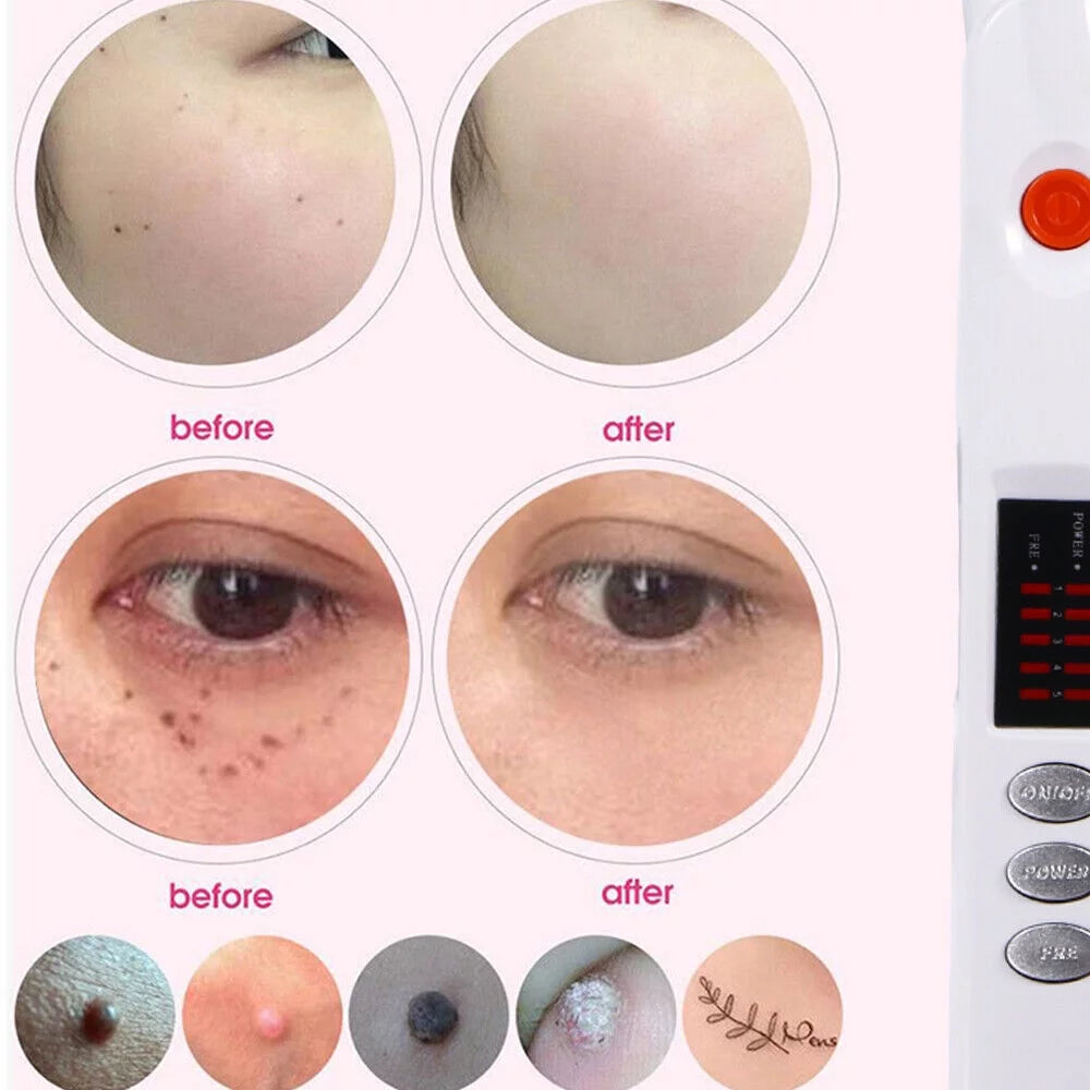 Plasma Laser Pen for Skin Spot and Wart Removal T3995